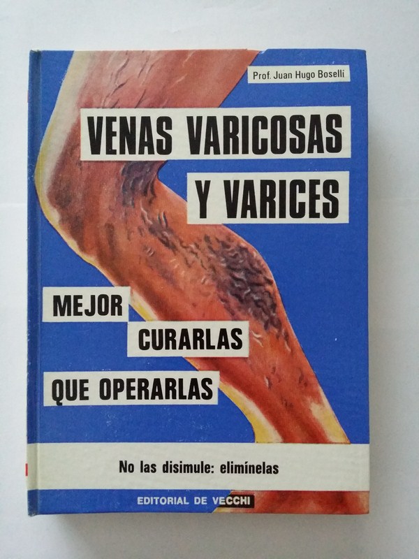 Venas varicosas y varices